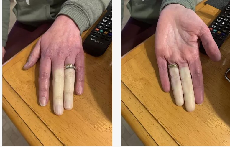 Почему несколько пальцев на руке могут неожиданно побелеть