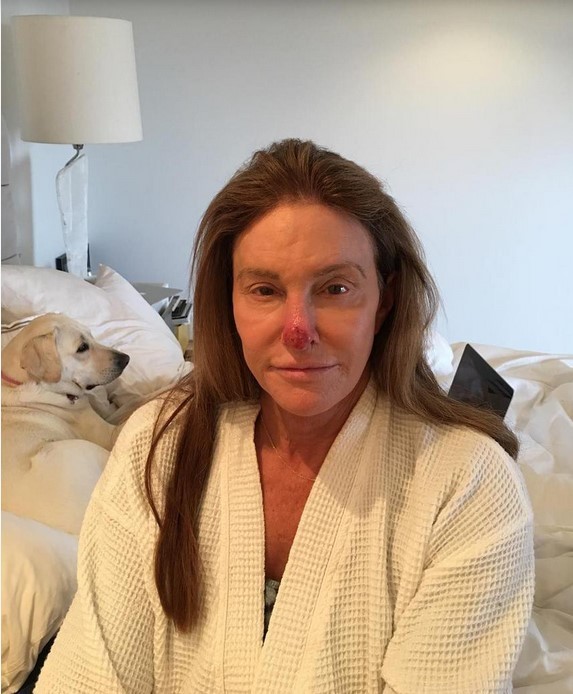 68-летняя Кейтлин Дженнер рассказала о раке кожи (ФОТО)