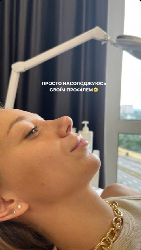  Дружина Віктора Павліка збільшила губи і порівняла фото до та після процедури 